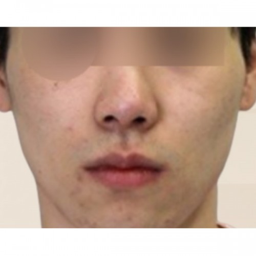 광대 카티 지방분해주사