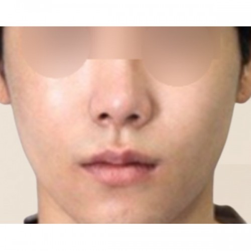 광대 카티 지방분해주사