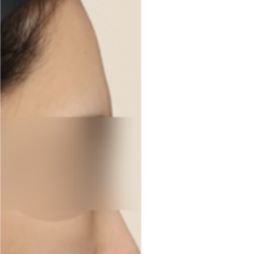 에그볼륨 페이스 바디 필러 (이마)