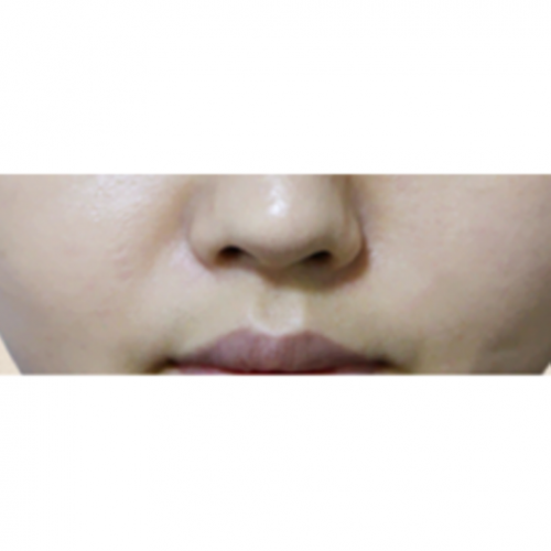 에그볼륨 콜라겐 주사 (팔자주름) 쥬베룩볼륨