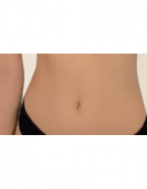 복부 카티 지방분해주사