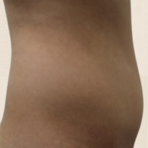 복부 카티 지방분해주사