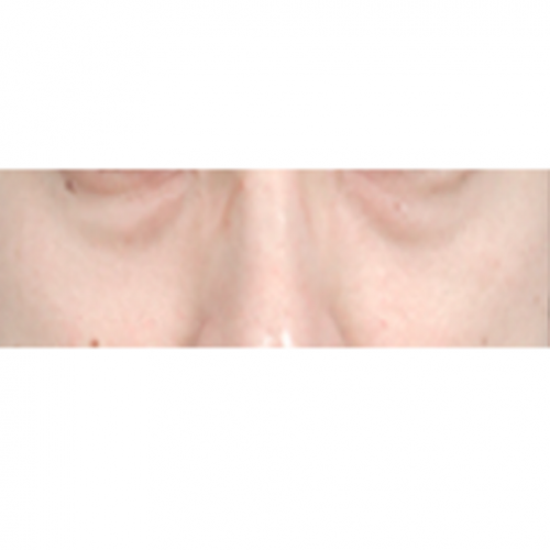 에그볼륨 콜라겐 주사 (눈밑꺼짐, 다크서클) 울트라콜