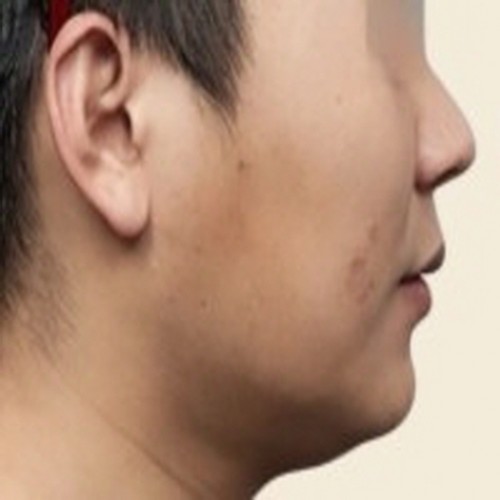 이중턱 페이스 카티시술