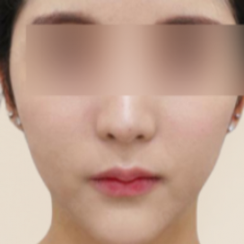 초음파 페이스 보톡스