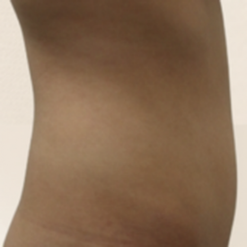 복부 카티 지방분해주사