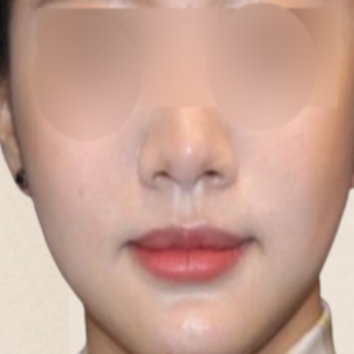 광대 카티 지방분해주사