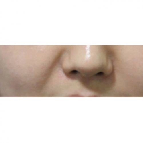 에그볼륨 콜라겐 주사 (팔자주름) 쥬베룩볼륨