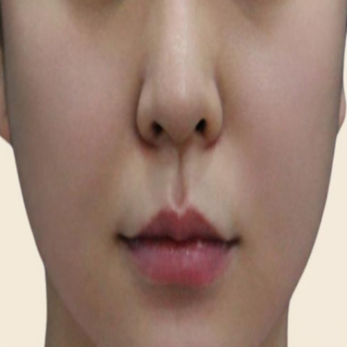 광대 카티 지방분해주사