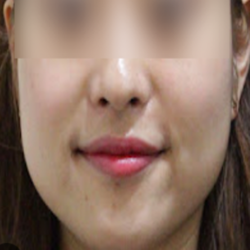 초음파 페이스 보톡스