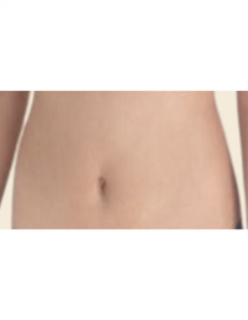 복부 카티 지방분해주사