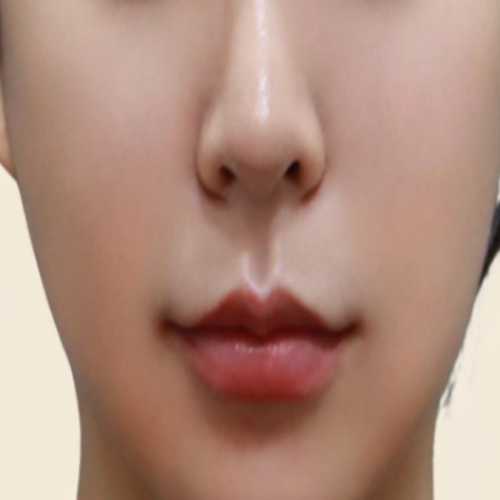 광대 카티 지방분해주사