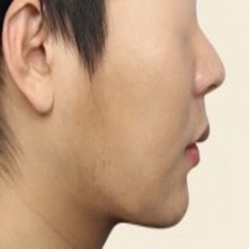 이중턱 페이스 카티시술