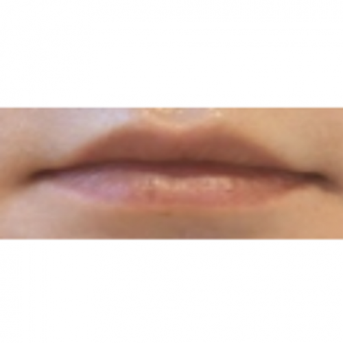 에그볼륨 페이스 바디 필러 (입술)