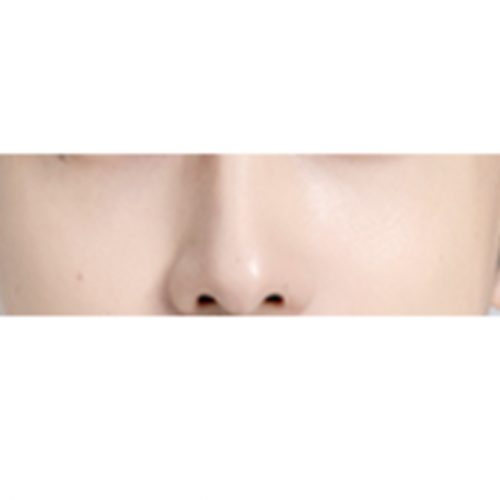 에그볼륨 콜라겐 주사 (눈밑꺼짐, 다크서클) 울트라콜