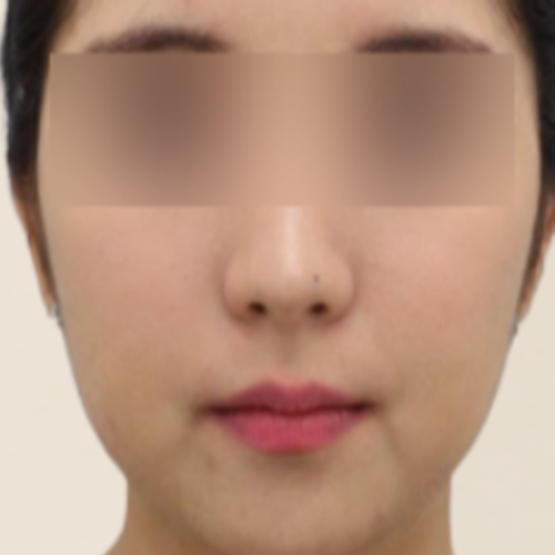 초음파 페이스 보톡스