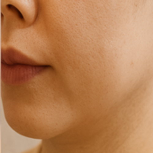 이중턱 카티 지방분해주사