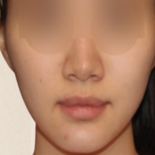 광대 카티 지방분해주사