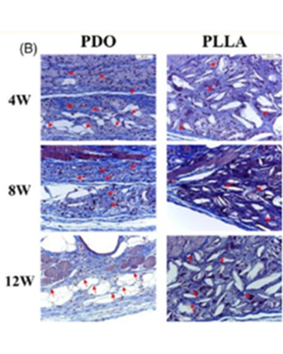 에그볼륨 콜라겐 주사