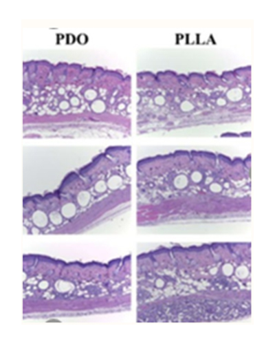 에그볼륨 콜라겐 주사