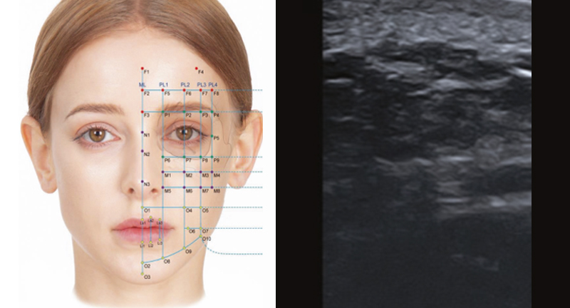 에그볼륨 콜라겐 주사